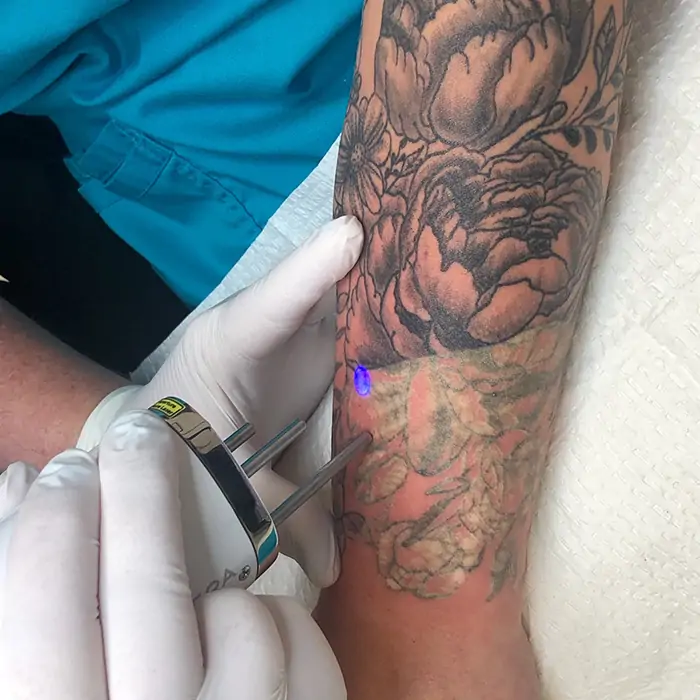 Laser handpiece positioned near an arm tattoo