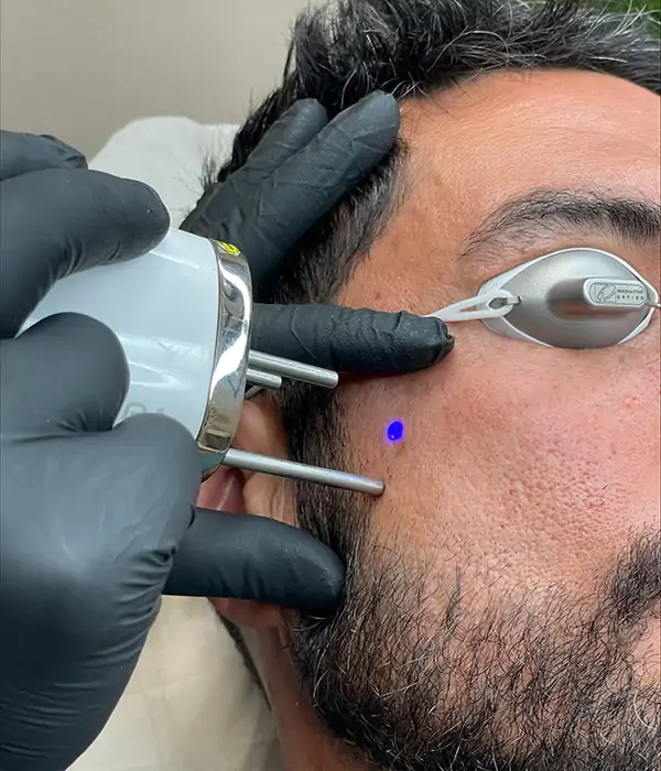 Facial laser treatment with protective eyewear