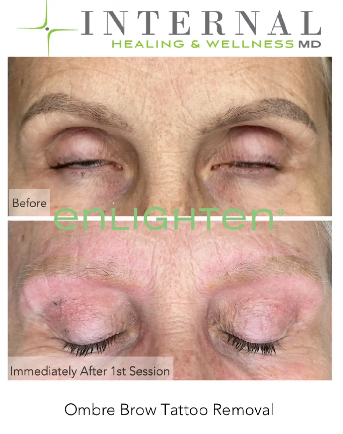 Ombre brow tattoo removal comparison, before treatment and immediately after the first session
